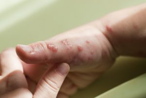 Chickenpox shingles blisters baby teens 