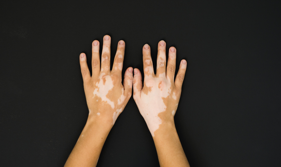 Vitiligo in Kids: All You Need to Know About It