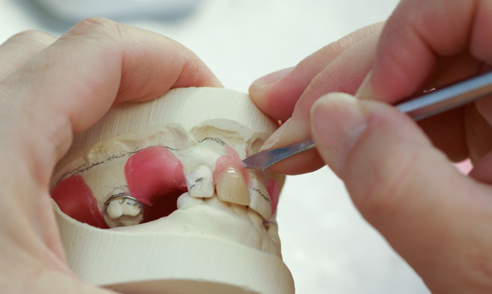 Dental professionals sometimes use acrylic material for denture repair.